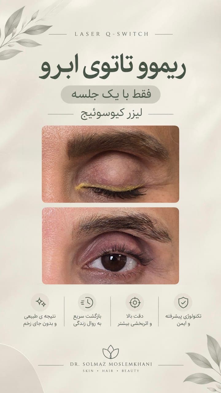 ریموو تاتوی ابرو با لیزر کیوسوئیچ