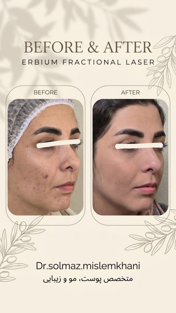 قبل و بعد لیزر اربیوم فرکشنال